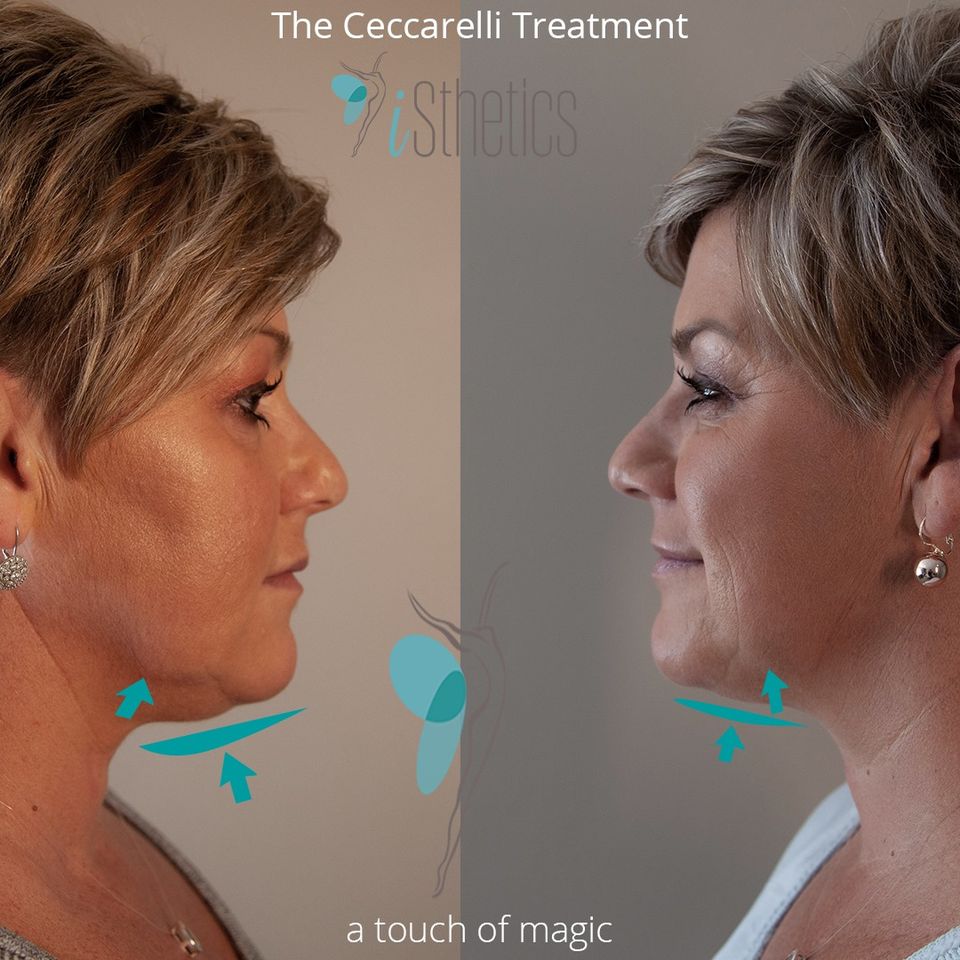 acne and acne scarring, ageing skin, antiageing and wellness, anti