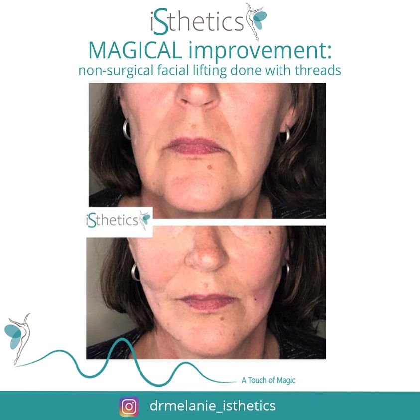 acne and acne scarring, ageing skin, antiageing and wellness, anti